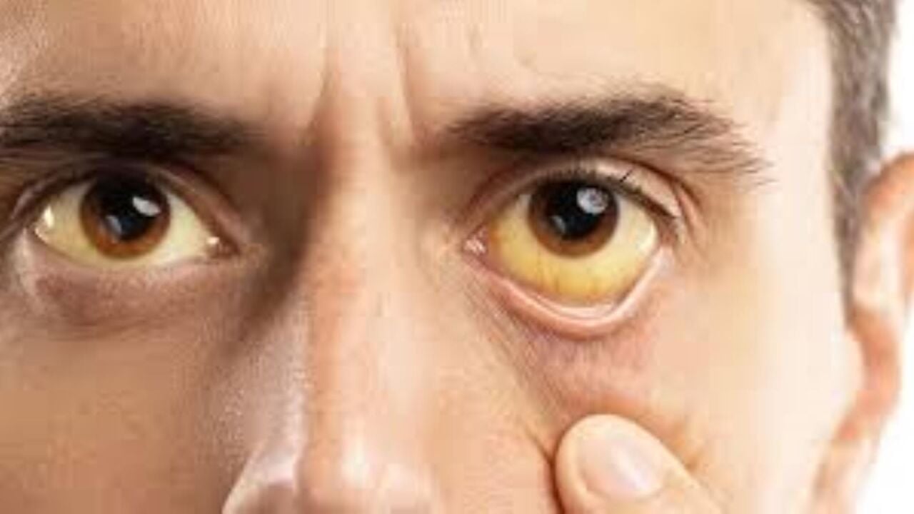 Bilirubin Nedir? Testi, Yüksekliği ve Düşüklüğü