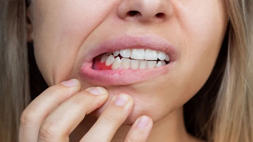 Skorbüt Nedir, Neden Olur? Belirtileri ve Tedavisi