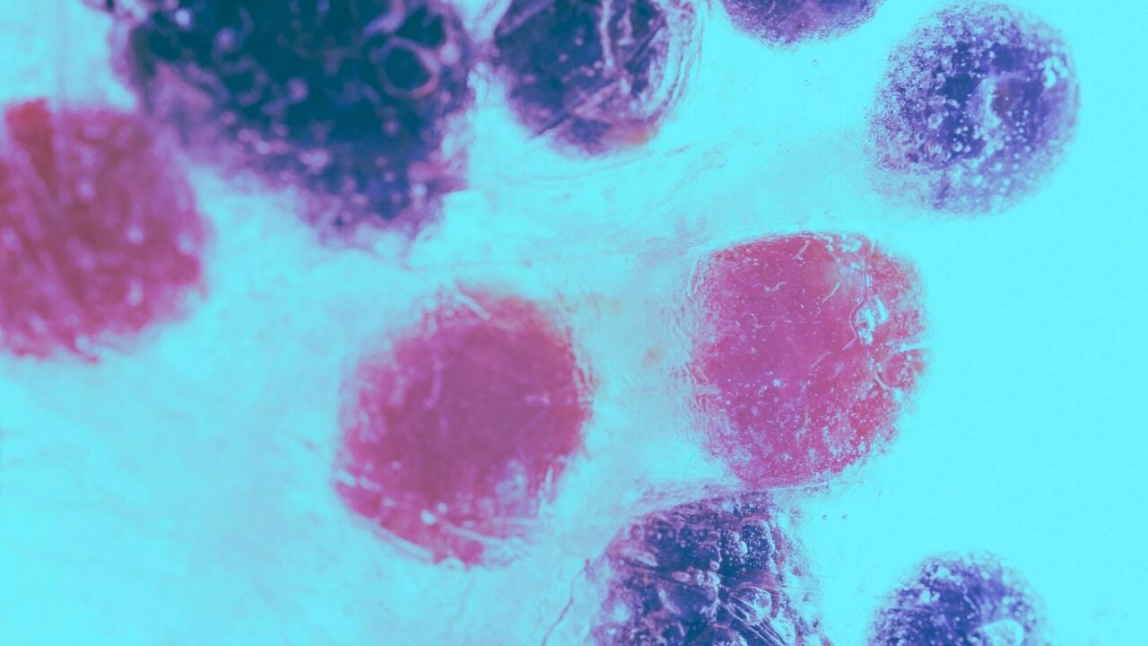 EOS (Eozinofil) Nedir? Yüksekliği ve Düşüklüğünün Belirtileri