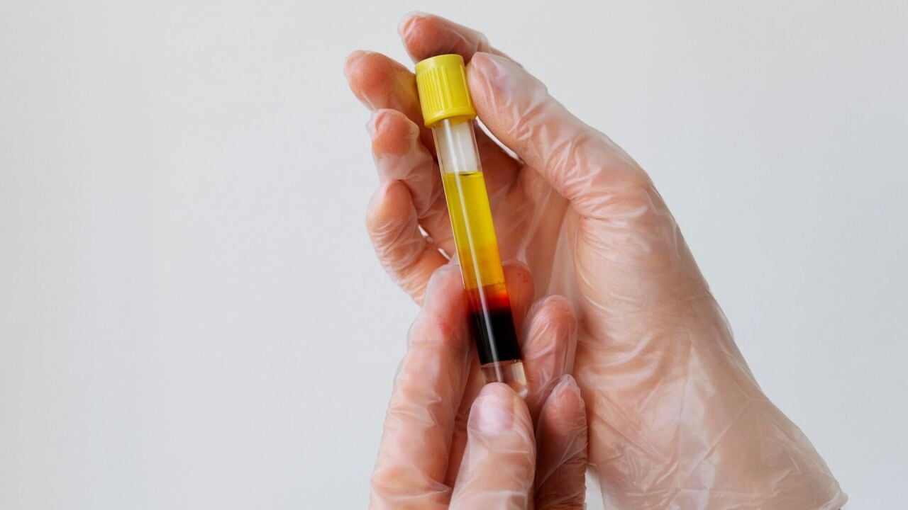 İdrarda Eritrosit Yüksekliği Nedir? Nedenleri ve Belirtileri