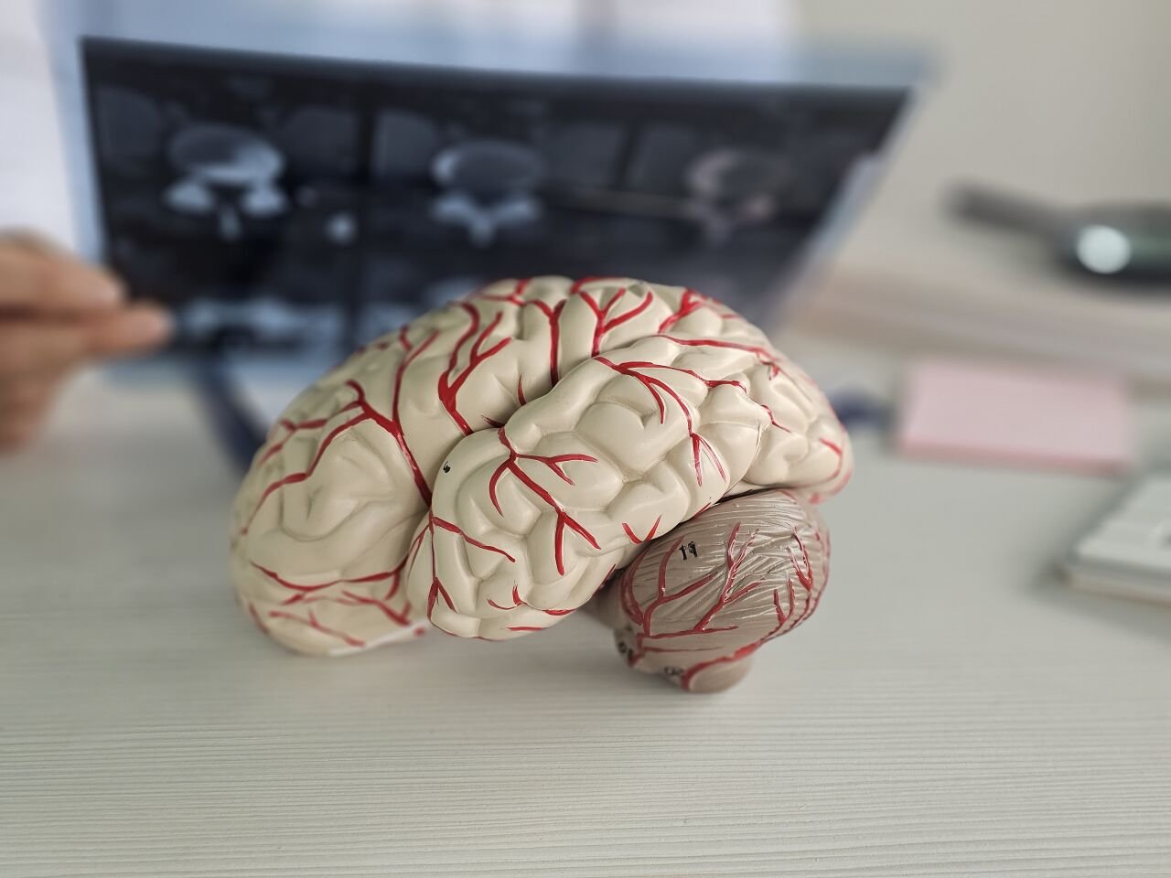 Beyin Sisi Nedir? Belirtileri, Nedenleri ve Bilimsel Çözüm Yolları